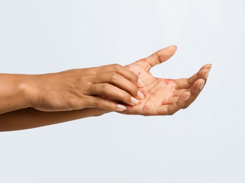 egzama-hangi-faktorlerle-tetiklenir